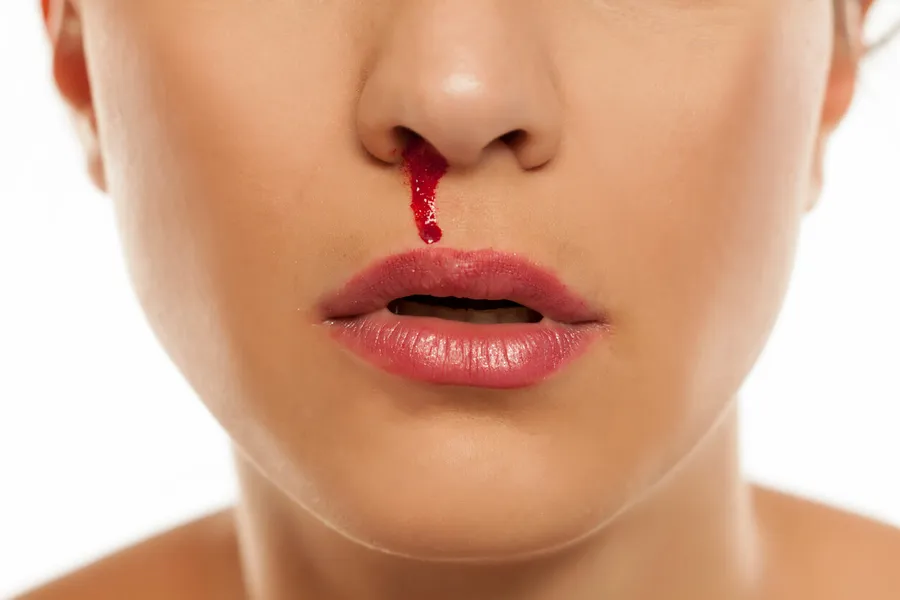 Person hält sich ein Tuch an die Nase wegen Nasenbluten durch Stress und erhöhten Blutdruck