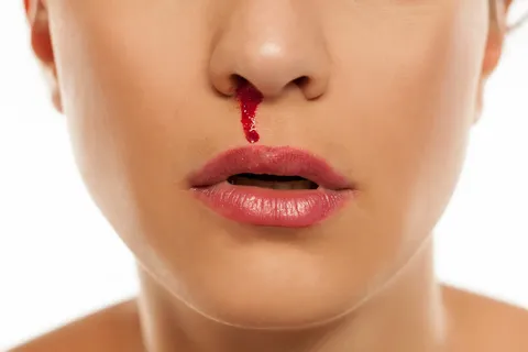 Person hält sich ein Tuch an die Nase wegen Nasenbluten durch Stress und erhöhten Blutdruck